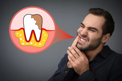 Read more about the article The Stages of Gum Disease and How to Prevent It